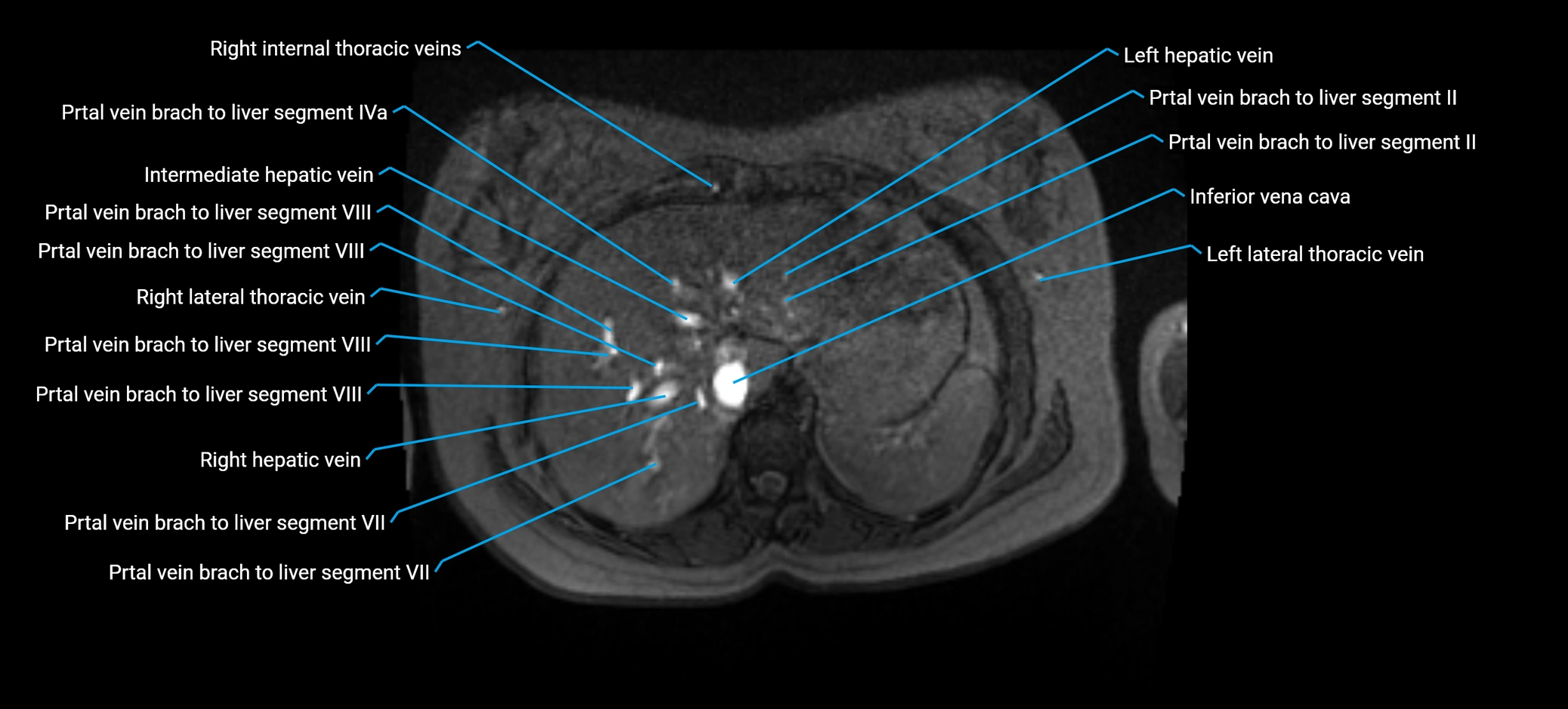 MRV abdomen pelvis & lower limb axial cross sectional anatomy labelled MRI image 28 (2).webp